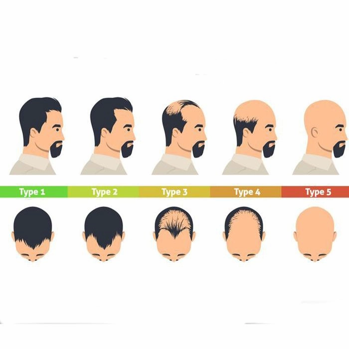 انواع ریزش مو 66