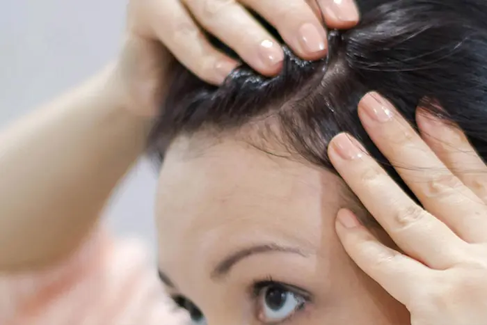 ریزش مو به دلیل چرب شدن پوست سر 654646412410