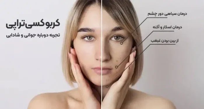 انواع کاربرد کربوکسی تراپی 455
