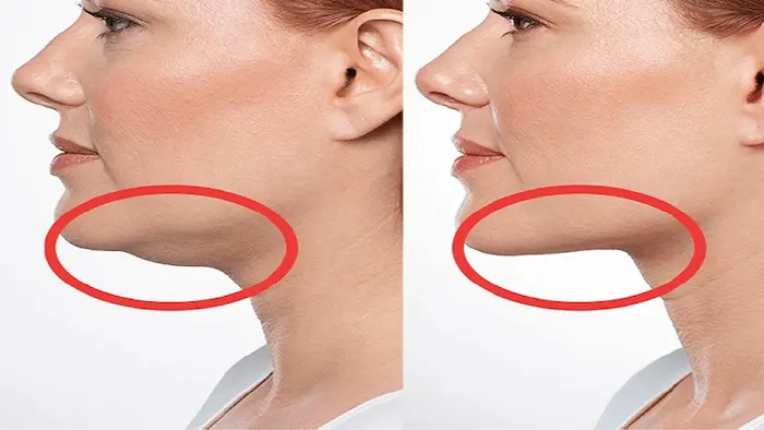 از بین بردن غبغب بعد از استفاده از دستگاه آراف مثلثی 654564564100