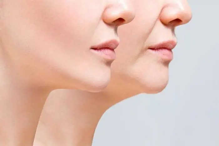 از بین رفتن غبغب با دستگاه آراف مثلثی 64566451