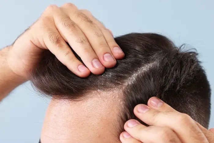 چربی کف سر مردان 52145645100