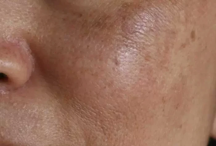 لک پوستی بر روی پوست چرب 5645645640