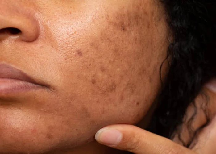 لک پوستی افراد تیره 564564656240