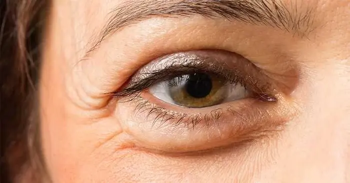 ایجاد پف زیر چشم در سنین بالا 654564610