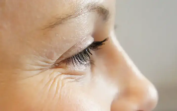افزایش چین و چروک های پنجه کلاغی دور چشم 654654100
