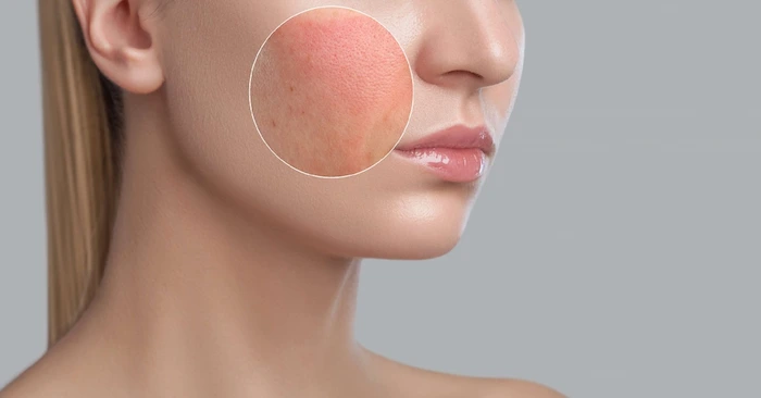 قرمزی پوست از عوارض پیلینگ صورت 596498