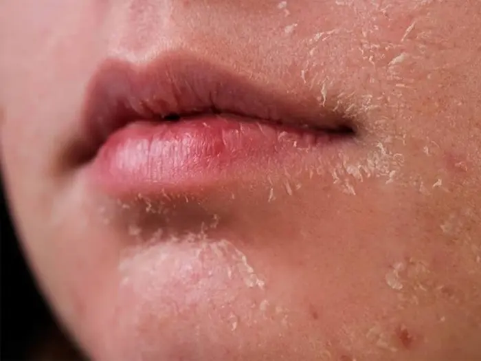 لکه شدن و شکستگی پوست صورت باکم آبی 75675655
