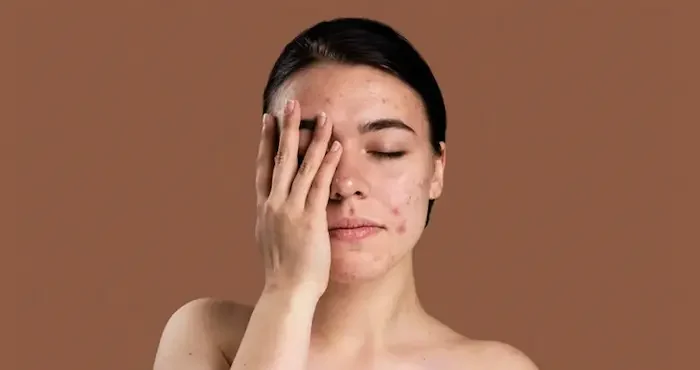 استرس و ایجاد لکه های پوستی 56546546546