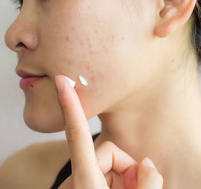 استفاده از مرطوب کننده روی صورت جوش دار و تفاوت آبرسان و مرطوب‌کننده 5464543543