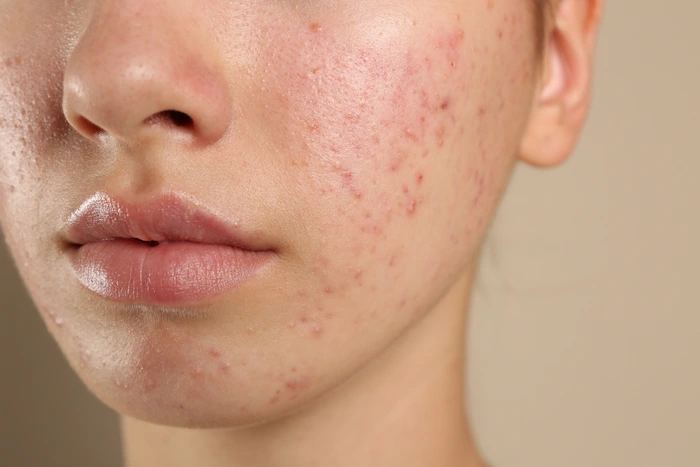اکنه روی پوست صورت 4584765486