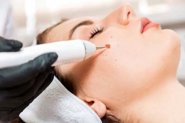 مراقبت های ضروری بعد از برداشتن خال صورت 6456563454
