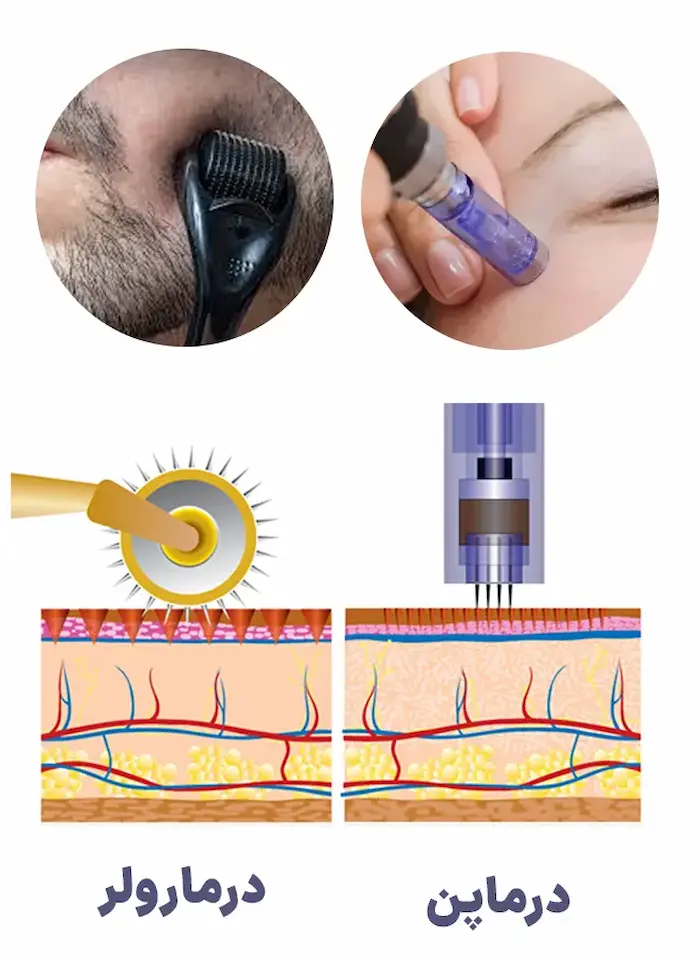روش های انجام شده درماپن و درمارولر روی صورت 534543534