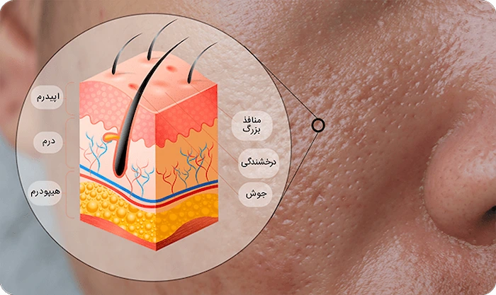 پوست چرب 41658416418