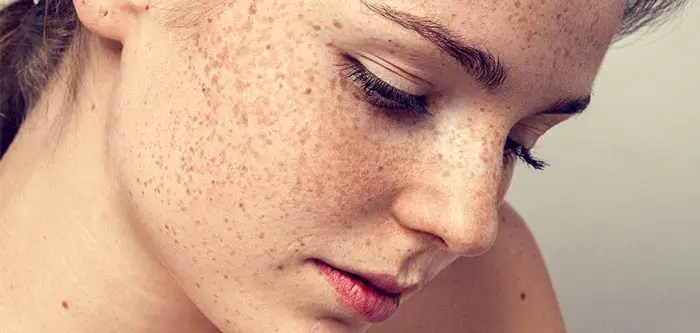 وجود لکه های کک و مک روی پوست صورت 54543543