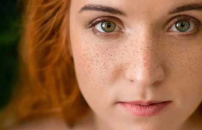 لکه های کک و مک روی صورت534543534534