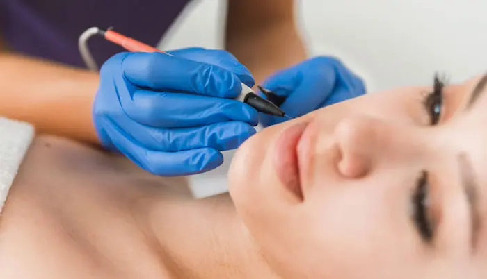 انجام دادن الکترولیز در نواحی چانه صورت 5345643534