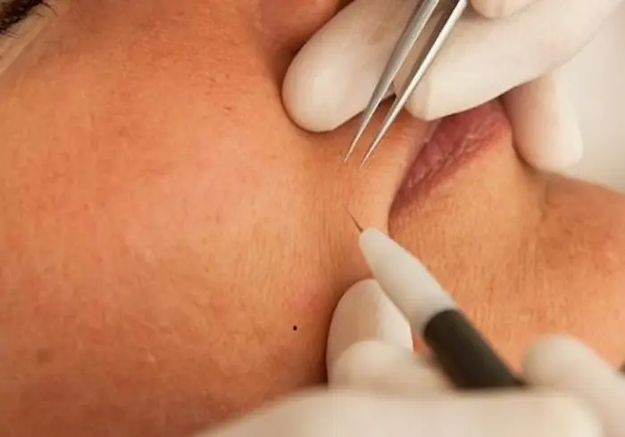 الکترولیز موهای زائد در ناحیه پشت لب صورت 454434