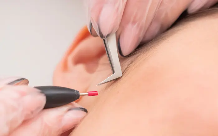 انجام دادن الکترولیز برای موهای ریز صورت 4543534543