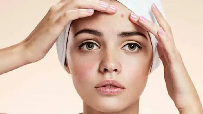 آشنایی و شناخت جوش پیشانی 54543534