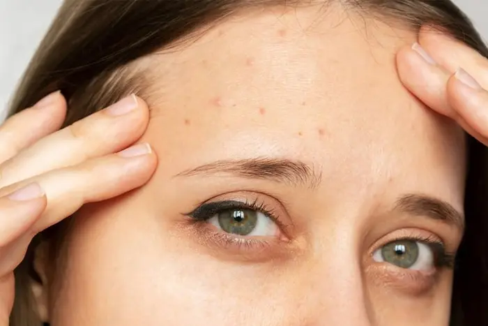 بروز جوش پیشانی 44234234