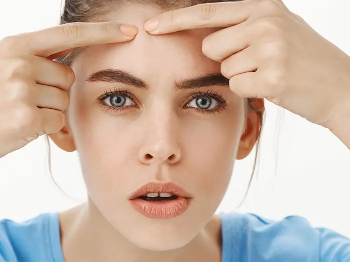 تشخیص انواع جوش پیشانی 6755656634