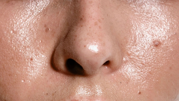 براقیت صورت به دلیل سبوم پوست 5645412