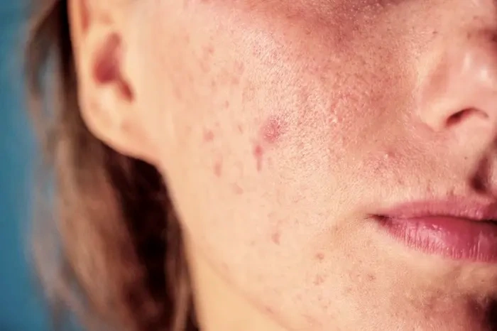 لک و آکنه پوستی 564564545