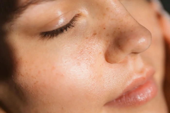 لک های پوستی به دلیل سبوم پوست 654421