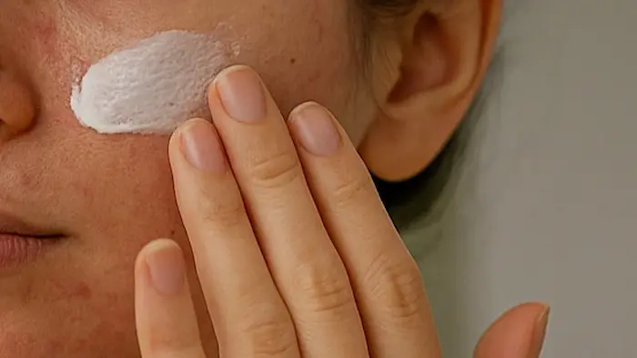 چگونگی مراقبت از لک ملاسما 5435345345