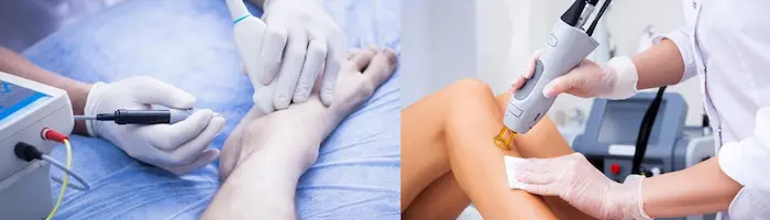 تفاوت روش الکترولیزر و لیزر موهای زائد 4545423