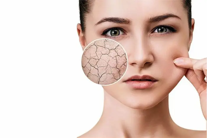 پوست خشک و دارای چروک های ریز 36456465410250