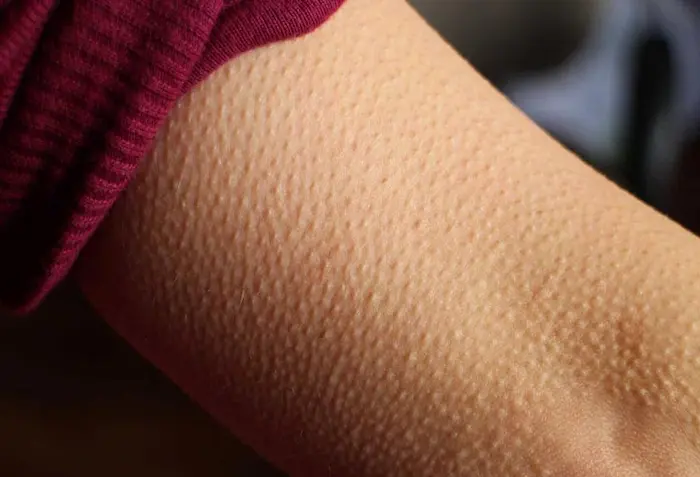 عوامل ایجاد پوست مرغی شدن بدن 34543532432