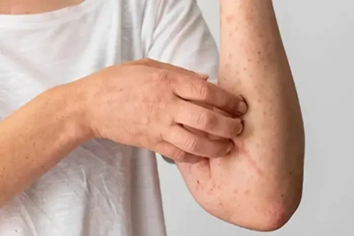 چگونگی تشخیص پوست مرغی شدن بدن 45345433