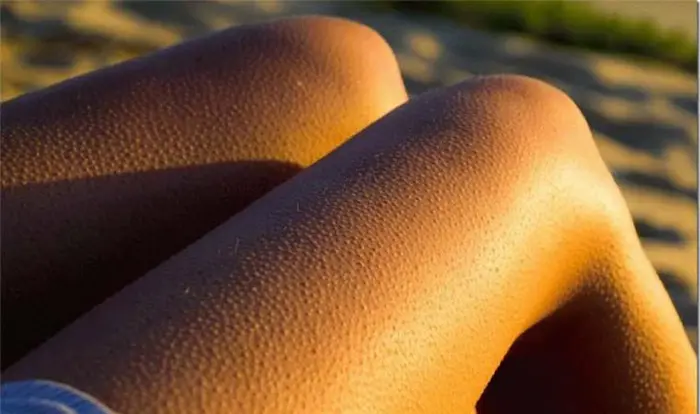  نرفتن زیر نور مستقیم افتاب و پیشگیری از پوست مرغی 454252423