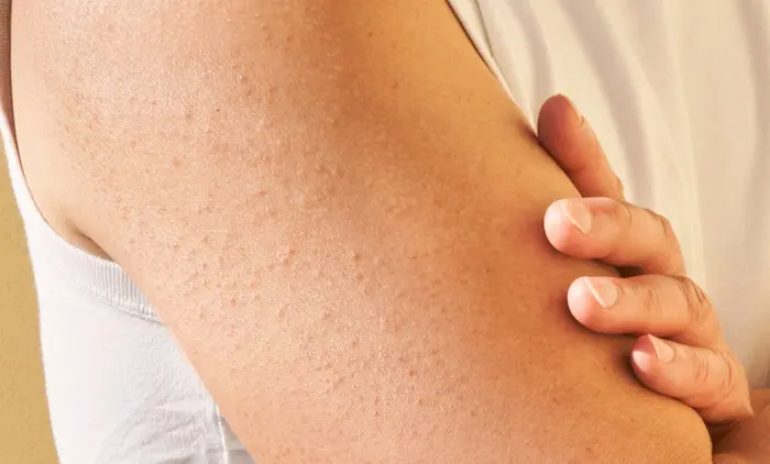 ایجاد پوست مرغی روی بدن 5643543543