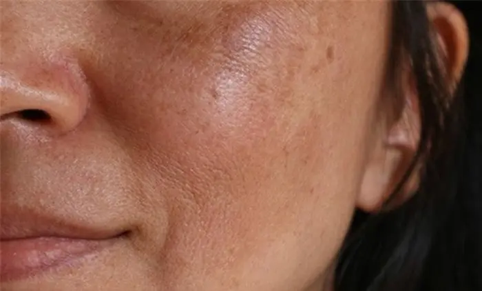 علت و رفع تیرگی پوست 56656555