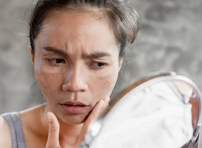 دیده شدن لکه های تیره روی پوست 435345324