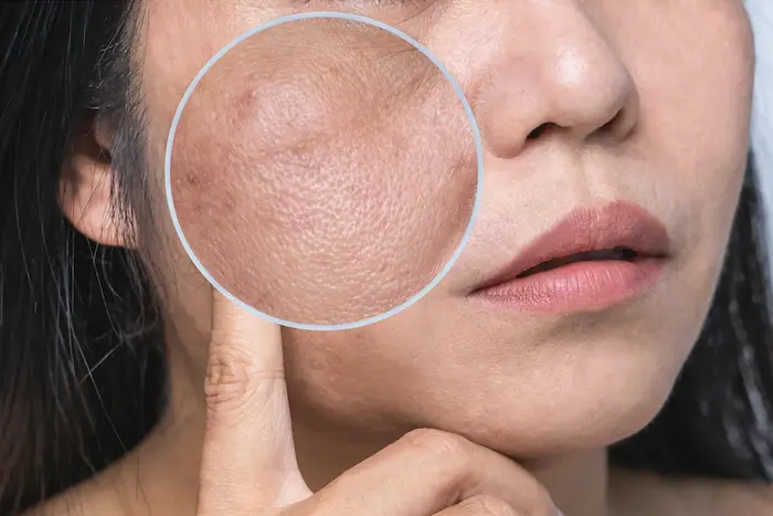 تیرگی قسمتی از صورت 6565665