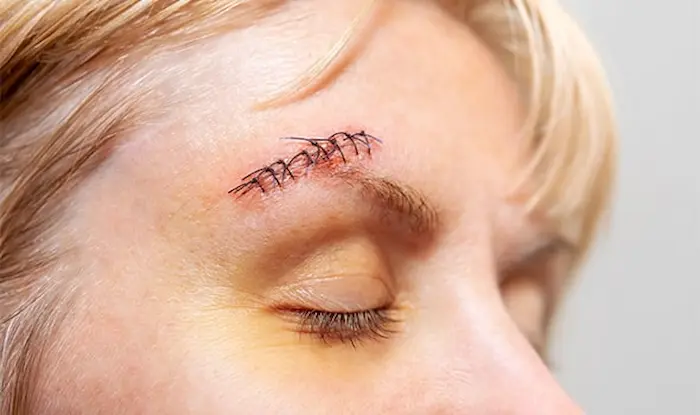 رفع جای بخیه روی پیشانی صورت 55435534