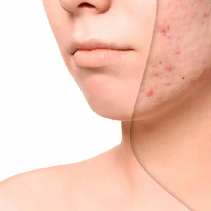 برطرف کردن جای جوش از روی صورت 5464565654