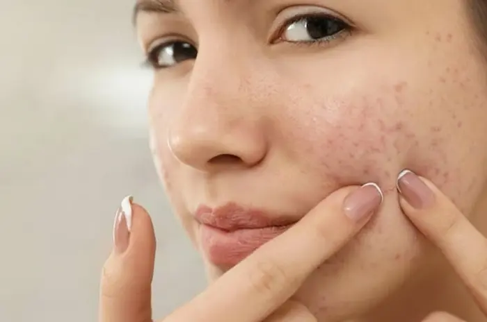 جای جوش و لکه روی صورت 6454656