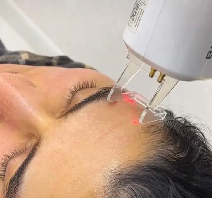 لیزر فرکشنال برای روی پیشانی 987543