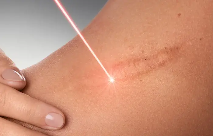 لیزر درمانی برای رفع جای بخیه 67565545