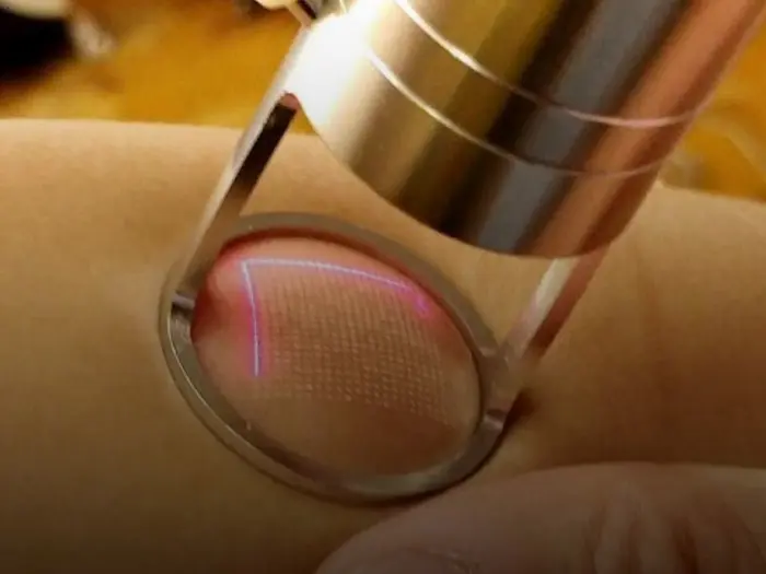 انجام دادن لیزر فرکشنال نقطه ای 8753380