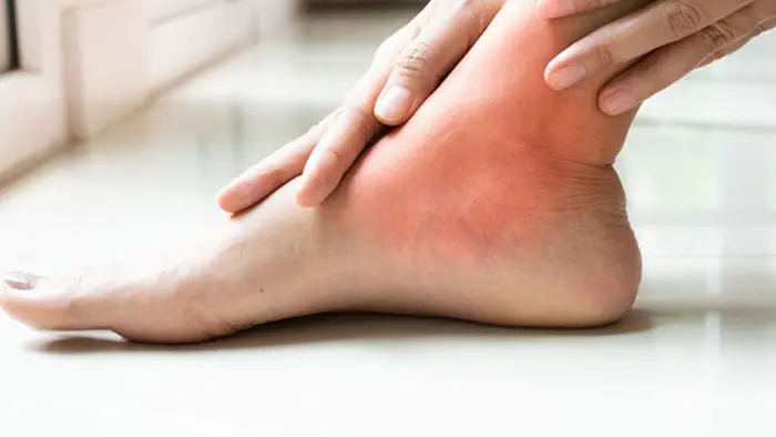 کفش مناسب نقرس پا 6534543543