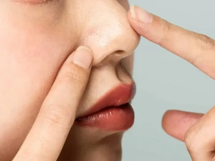 علت چربی بینی 34234234