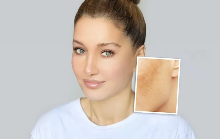 از بین بردن لک صورت با ضدآفتاب 564658484321