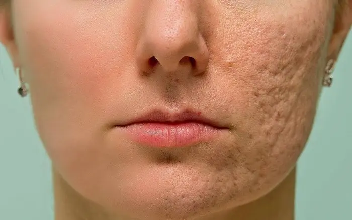 نشانه هامنافذباز پوست روی صورت 5464565454