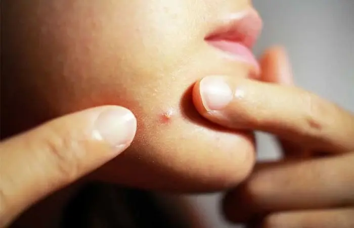 علائم کورک پوستی روی چونه 6765753432